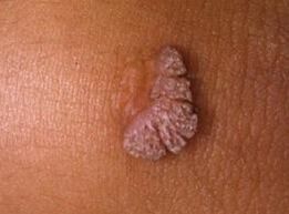 ljudski papiloma virus što je to